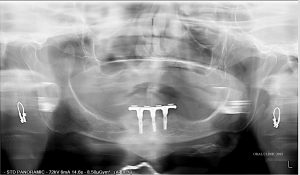 REHABILITATION COMPLETE SUR IMPLANTS ET DENTS NATURELLES - ORAL CLINIC