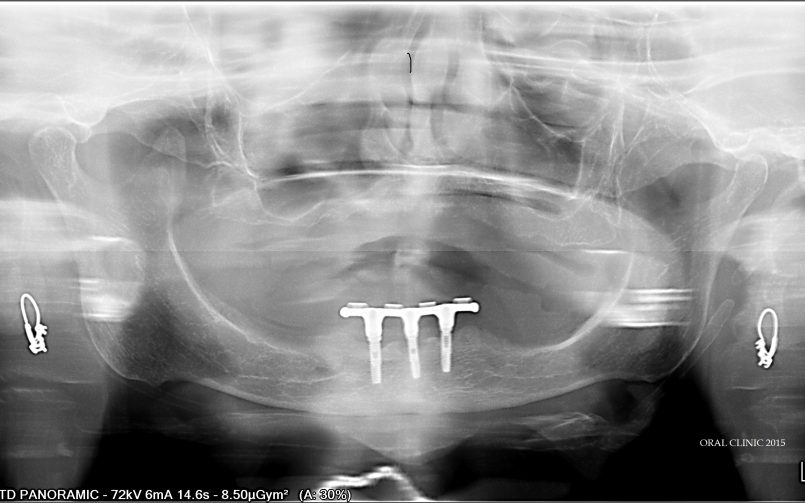 REHABILITATION COMPLETE SUR IMPLANTS ET DENTS NATURELLES - ORAL CLINIC