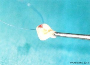 Implant-Dentaire-Pas-Cher-Espagne-Regeneration-Osseuse-moins-de-douleurs-post-opératoires