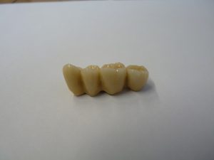 Implant-Dentaire-Dentiste-Espagne