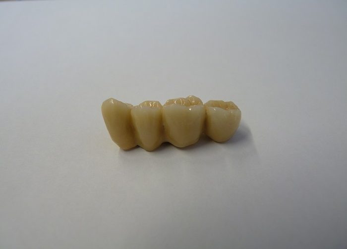 Implant-Dentaire-Dentiste-Espagne