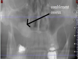 Implant-Dentaire-Pas-Cher-Espagne-Regeneration-Osseuse-elevation-sinus