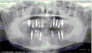REHABILITATION COMPLETE SUR IMPLANTS ET DENTS 2