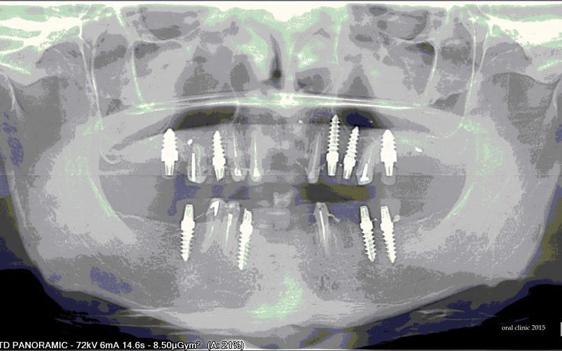 REHABILITATION COMPLETE SUR IMPLANTS ET DENTS 2