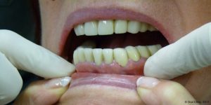 Dentiste-Pas-Cher-Espagne-Prothese-Ceramo-Metallique-Resultat