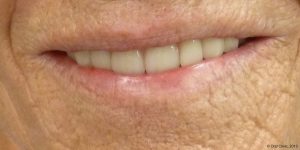 Prothèse maximillaire pas chere clinique en espagne. Solutions de prothese dentaire maxillaire hybride fixe à un bon rapport qualité prix.