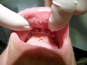 Implant-Dentaire-Pas-Cher-Espagne-Type-connexion-externe-ou-interne