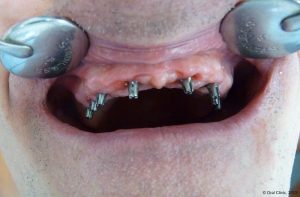 Implant-Dentaire-Pas-Cher-Espagne-Type implants monoblocs