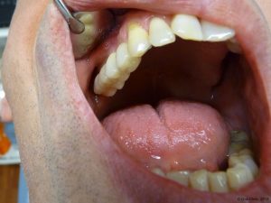 Implant-Dentaire-Pas-Cher-Espagne-Nos-Implants-BREDENT-CIRCONIO