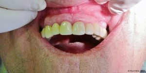 Dentiste-Pas-Cher-Espagne-Prothese-Ceramo-Metallique-Resultat-1