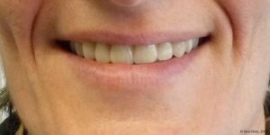 Prothèse maximillaire clinique dentaire espagne. Oral Clinic: clinique offrant un service de dentiste pas cher mais de qualité en Espagne.