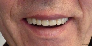 Prothèse maximillaire pas chere clinique dentaire espagne. Offre des solutions de prothese dentaire maxillaire hybride fixe à un bon rapport qualité prix.