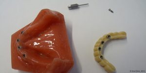 Pose d'une prothese dentaire maximillaire. Oral Clinic: clinique offrant un service de dentiste pas cher mais de qualité en Espagne