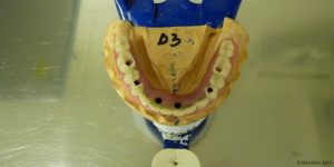 Pose d'une prothese dentaire clinique Espagne. Oral Clinic: clinique offrant un service de dentiste pas cher mais de qualité en Espagne