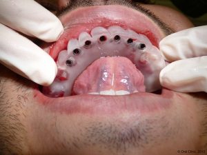 Implant-Dentaire-Pas-Cher-Espagne-Intervention