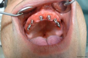 Implant-Dentaire-Pas-Cher-Espagne-Type-Implant-Monobloc