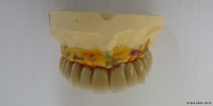 Dentiste-Pas-Cher-Espagne-Prothese-Ceramo-Metallique-Resultat-3