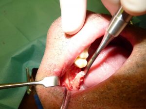 Implant-Dentaire-Pas-Cher-Espagne-Regeneration-Osseuse-Autogreffes