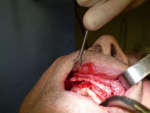 Implant-Dentaire-Pas-Cher-Espagne-Regeneration-Osseuse