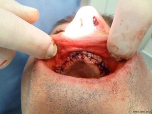 Implant-Dentaire-Pas-Cher-Espagne-Regeneration-Osseuse-préservation-des-éléments-anatomiques-sensibles