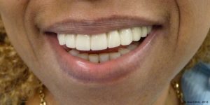 Dentiste-Pas-Cher-Espagne-Prothese-Ceramo-Metallique-Resultat