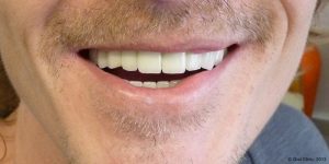 Dentiste-Pas-Cher-Espagne-Prothese-Ceramo-Metallique-Resultat-5