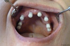 Implant-Dentaire-Pas-Cher-Espagne-Type - tampon de silicone protègent le moignon après l'intervention jusqu'a la pose du bridge provisoire prévue le lendemain.