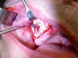 Implant-Dentaire-Pas-Cher-Espagne-Regeneration-Osseuse-préservation-des-tissus-mous