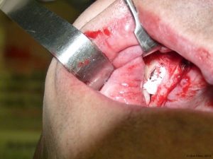 Implant-Dentaire-Pas-Cher-Espagne-Regeneration-Osseuse-préservation-des-tissus-mous