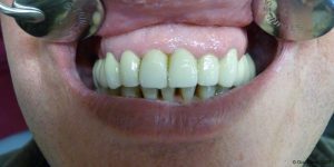 Dentiste-Pas-Cher-Espagne-Prothese-Ceramo-Metallique-Resultat-7