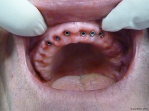 Implant-Dentaire-Pas-Cher-Espagne-Type-connexion-externe-ou-interne
