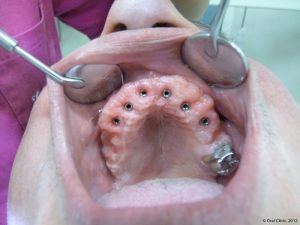 Implant-Dentaire-Pas-Cher-Espagne-Type