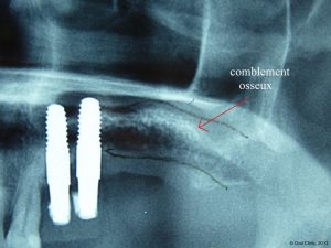Implant-Dentaire-Pas-Cher-Espagne-Regeneration-Osseuse