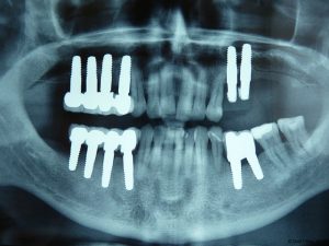 Implant-Dentaire-Pas-Cher-Espagne-Nos-Implants