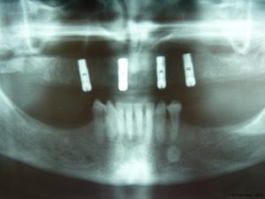 Implant-Dentaire-Pas-Cher-Espagne-Nos-Implants-nobel-bio