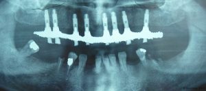 Implant-Dentaire-Pas-Cher-Espagne-Nos-Implants