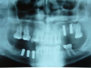 Implant-Dentaire-Pas-Cher-Espagne-Nos-Implants