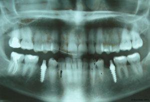Implant-Dentaire-Pas-Cher-Espagne-Nos-Implants-trinon