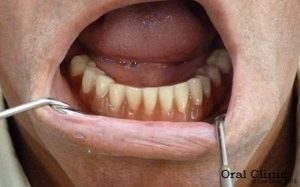 Prothese dentaire avec élément boule pas cher avec Clinique dentaire espagne Oral Clinic