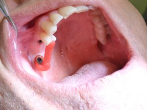 Implant-Dentaire-Cas-clinique