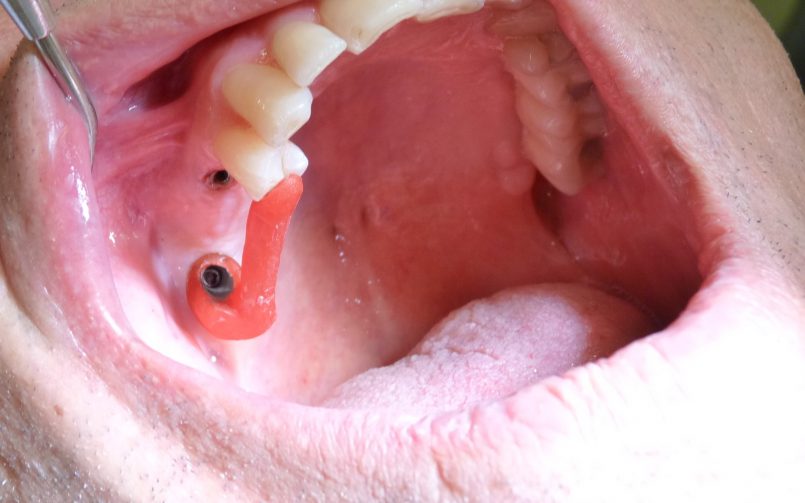 Implant-Dentaire-Cas-clinique