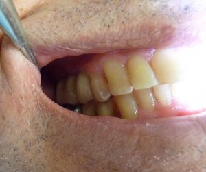 Implant-Dentaire-Dentiste-Espagne