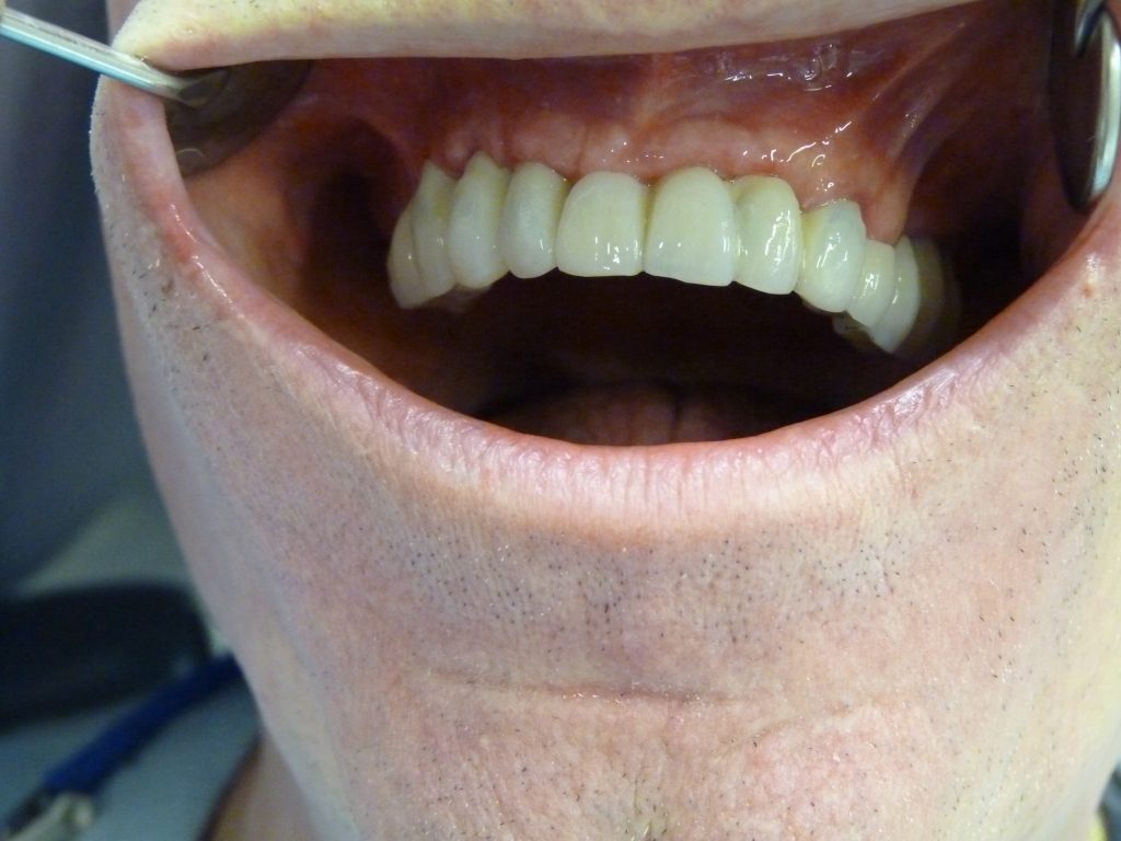 POSE PROTHESE HYBRIDE FIXE TRANSVISEE