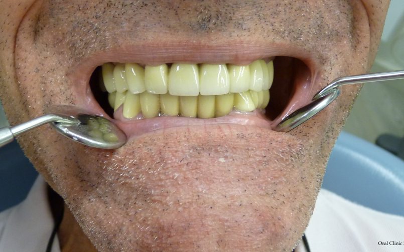 REHABILITATION COMPLETE SUR IMPLANTS ET DENTS 3