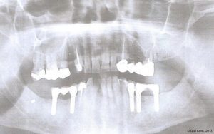 Implant-Dentaire-Pas-Cher-Espagne-Nos-Implants-STRAUMANN