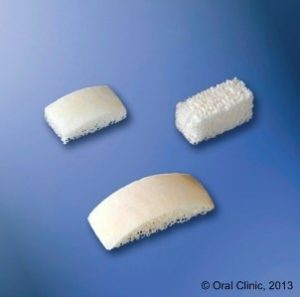 Bloc et plaquettes Implant-Dentaire-Pas-Cher-Espagne-Regeneration-Osseuse