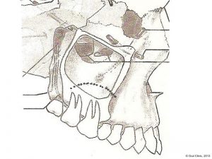 Implant-Dentaire-Pas-Cher-Espagne-Regeneration-Osseuse-elevation-sinus