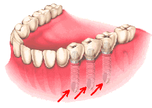 Implant dentaire et pose d'implants dentaires en Espagne. Oral Clinic vous informe sur les implants dentaires en Espagne