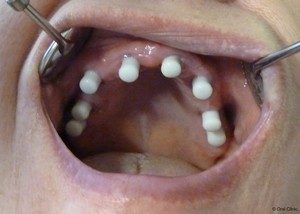Implant dentaire et pose d'implants dentaires en Espagne. Chirurgie - Implantologie - Informations