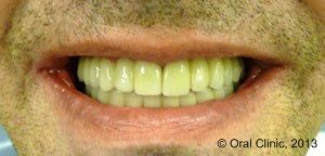 Implant-Dentaire-Pas-Cher-Espagne-Homme